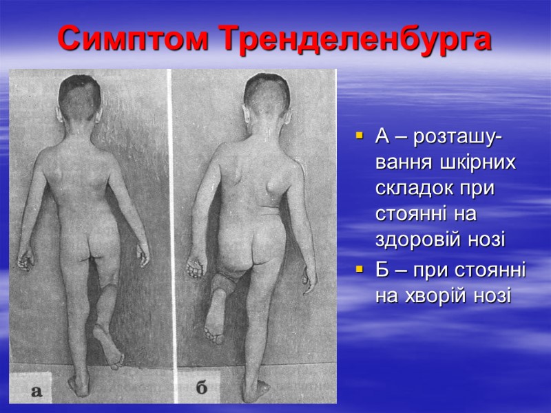 Симптом Тренделенбурга А – розташу-вання шкірних складок при стоянні на здоровій нозі Б –